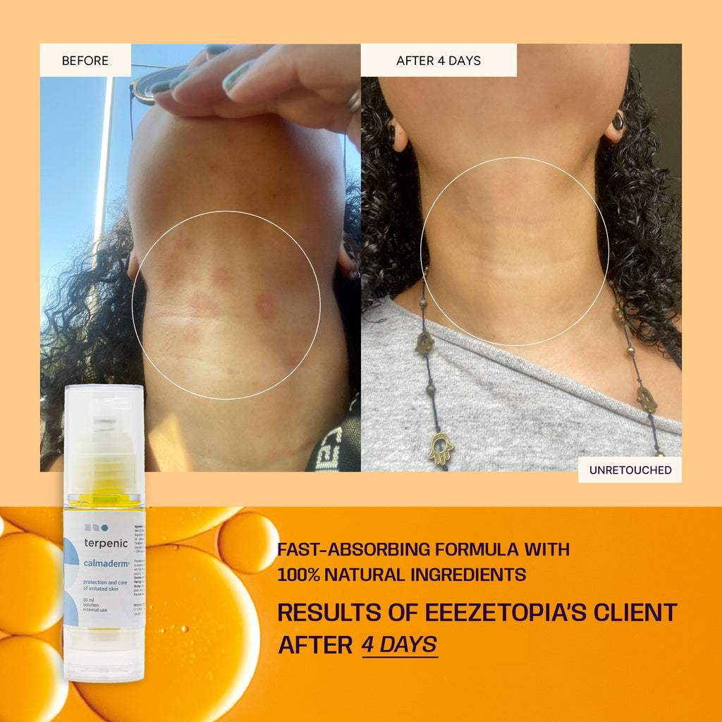 Calmaderm® - Irritated Skin Care Oil | Eeezetopia